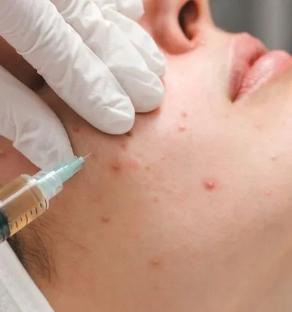 Acne Injection In Orlando, FL | Windermere Medical Spa