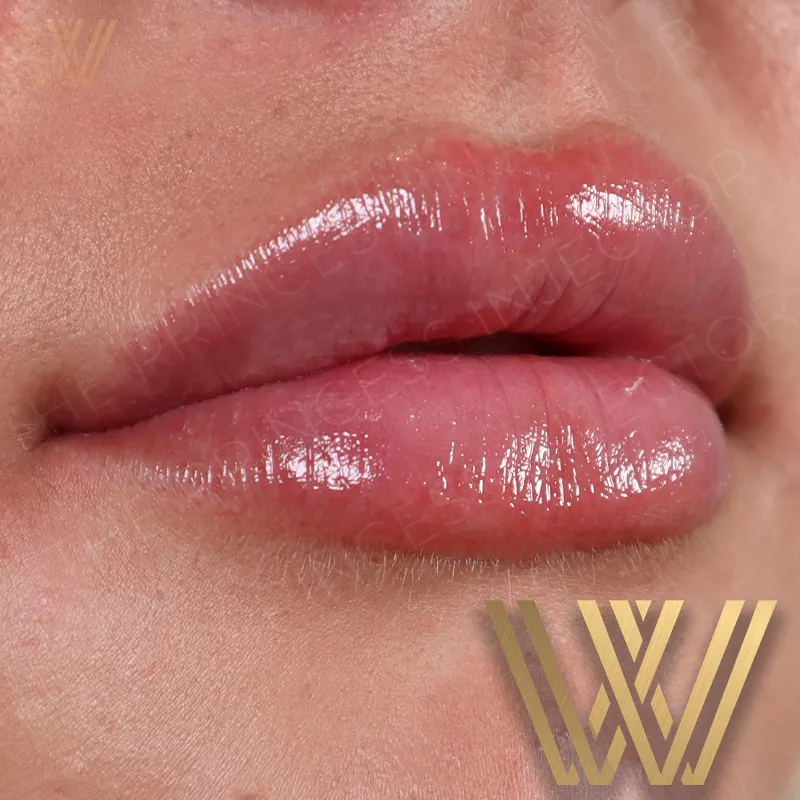 Lip Filler In Orlando, FL | Windermere Medical Spa