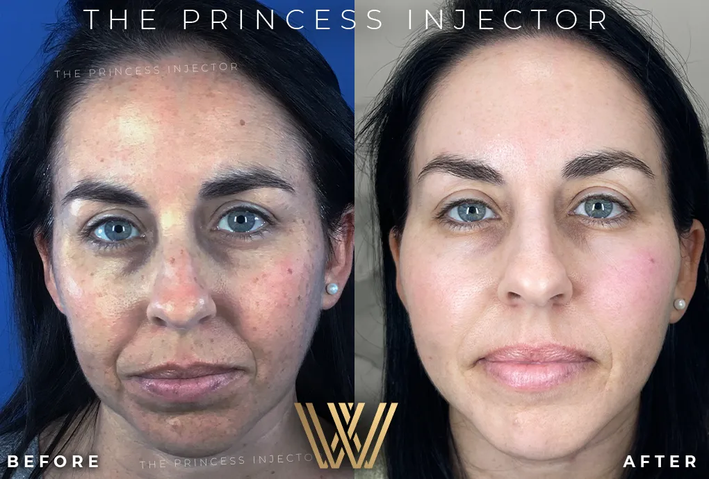 Princess Injector Sculptra B In Orlando, FL | Windermere Medical Spa