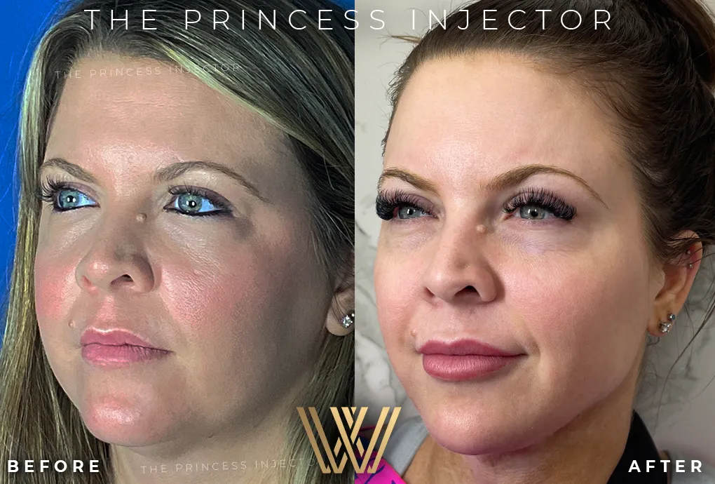 Princess Injector In Orlando, FL | Windermere Medical Spa