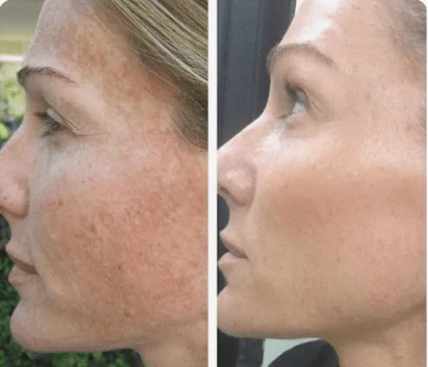 VI Treatment Before After In Orlando, FL | Windermere Medical Spa