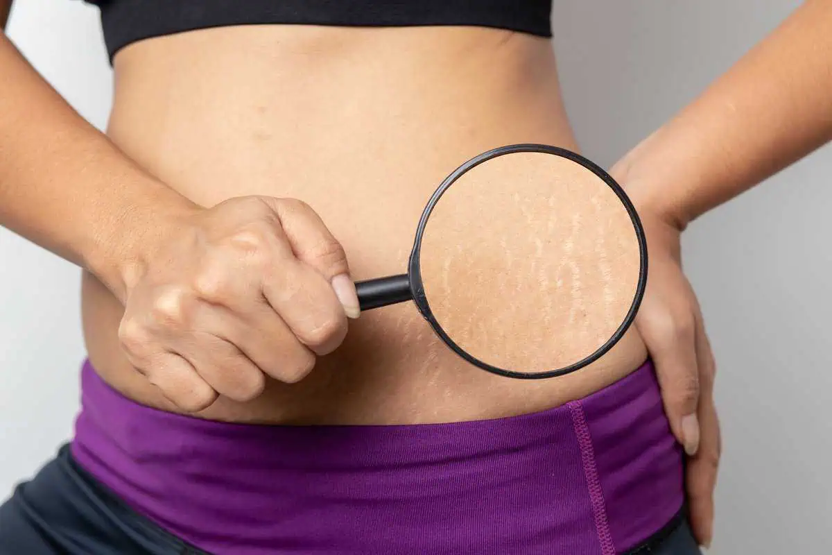 Stretch mark treatment at Windermere Medical Spa Orlando