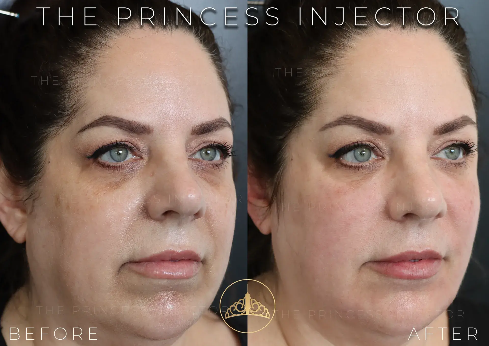 MK Filler | Sculptra in Orlando | Windermere Medical Spa