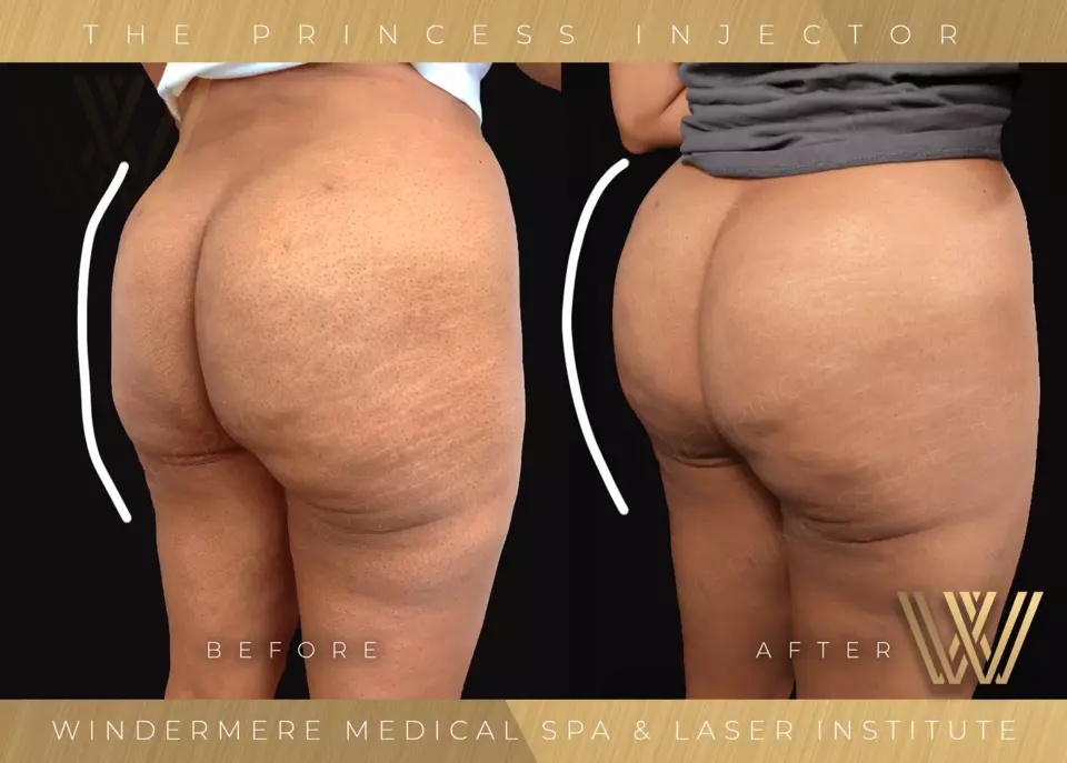 Sculptra Butt Lift After Before at Windermere medical Spa