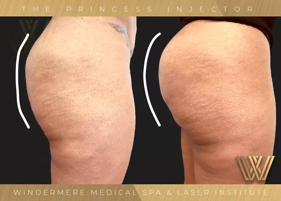 Sculptra Butt Lift After Before at Windermere medical Spa