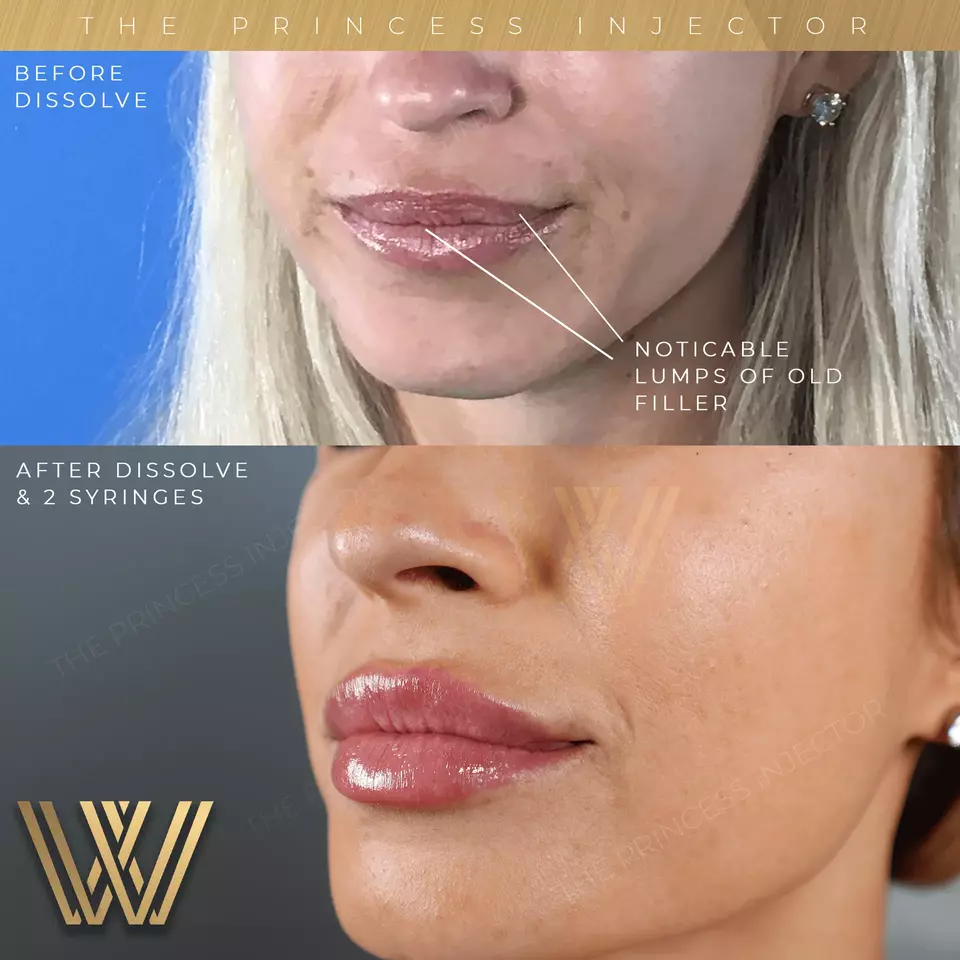 MK Pout Lip Enhancement Results at Windermere medical Spa