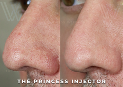 MK Pore Before after at Windermere medical Spa