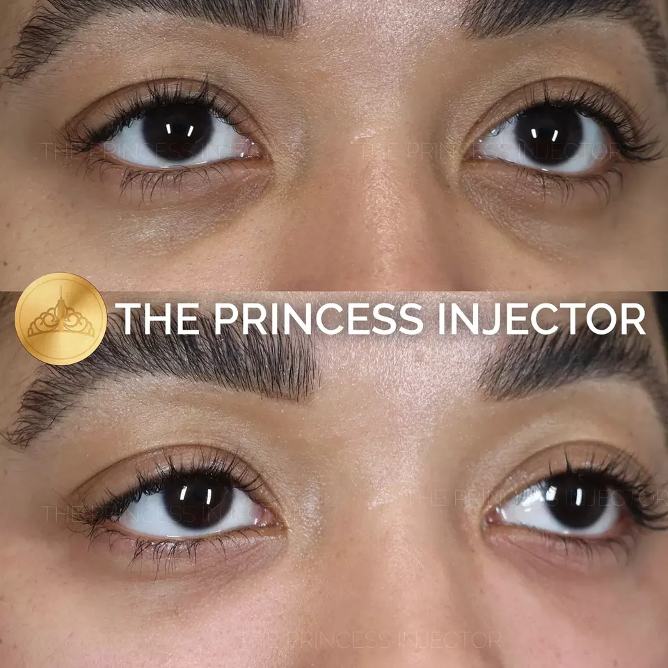 PRP For Dark Circles in Orlando, at Windermere medical Spa