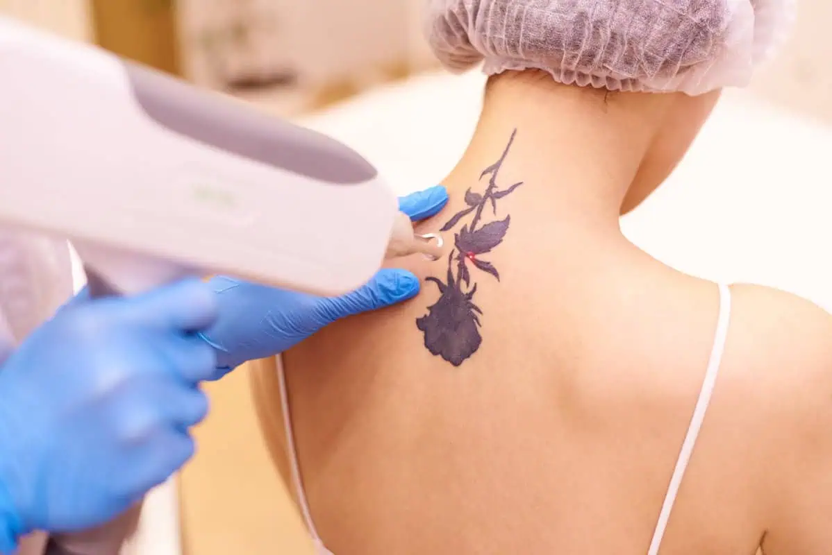 Tattoo Removal by Windermere Medical Spa in Orlando, FL