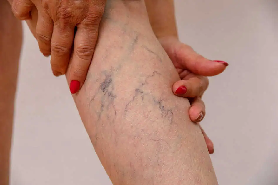 Varicose and spider veins by Windermere Medical Spa & Laser Institute in Taborfield Ave Orlando, FL