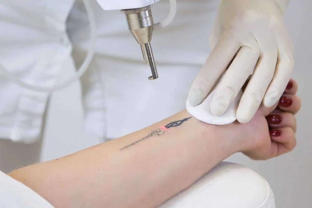 Hollywood Spectra Laser Tattoo Removal at Windermere Medical Spa